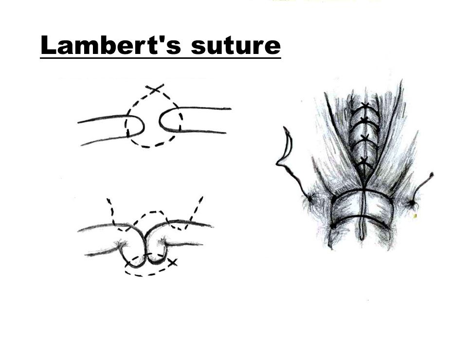 utrecht investing suture pattern